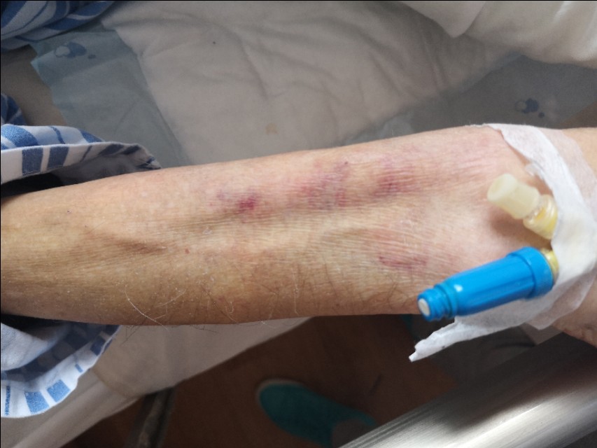 中西医结合治疗原因不明肠梗阻、腹水转氨酶明显升高病案一例！