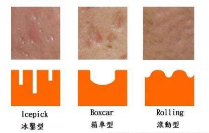 祛疤痕实拍,祛疤痕误区