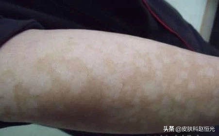 得了汗斑,当心传染别人,皮肤科医生说要做好这3点