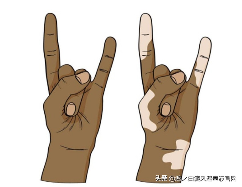 308激光治疗仪治白癜风多少钱一台,白癜风做308激光一个疗程为多少钱