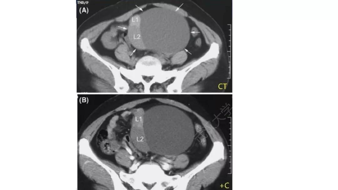 卵巢原发肿瘤的分析思路