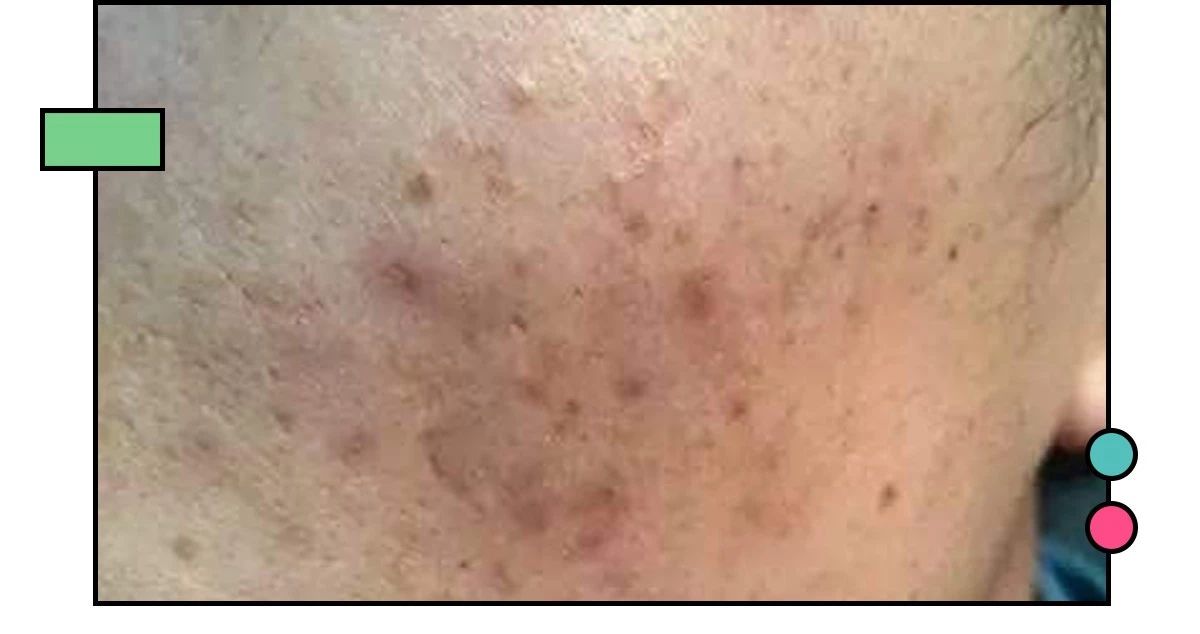 如何祛痘印?看了这篇能解决你大部分的问题!