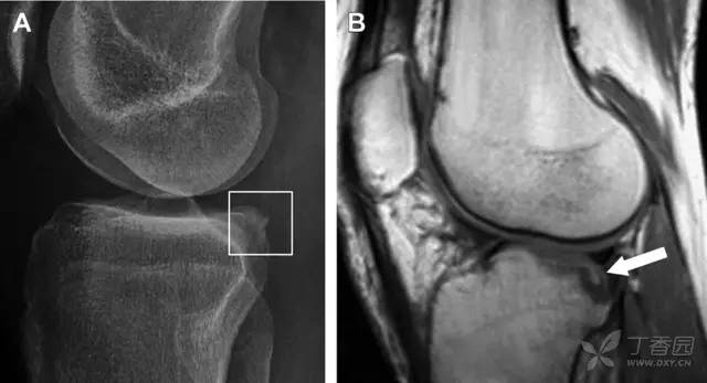 常见的八种骨折,容易漏诊的肩关节骨折