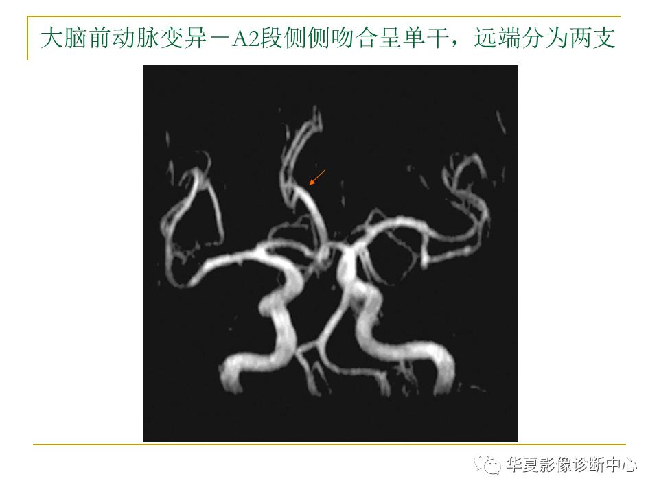 中国人脑立体定向mri应用解剖图谱,脑mri示意图