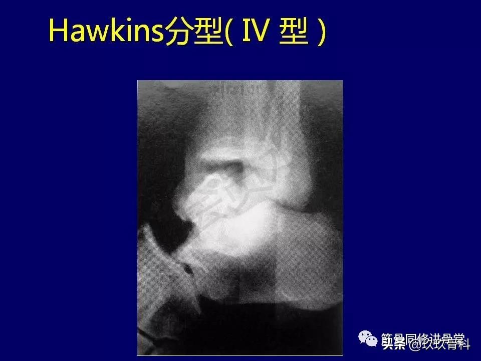 距骨骨折的治疗原则,距骨骨折如何调理