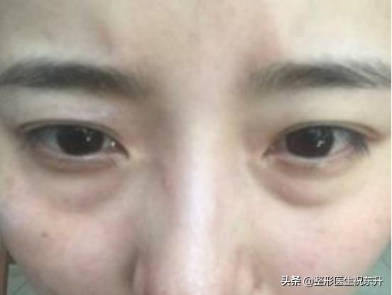 填泪沟可以用自己眼袋填吗,填泪沟可以解决眼袋问题吗