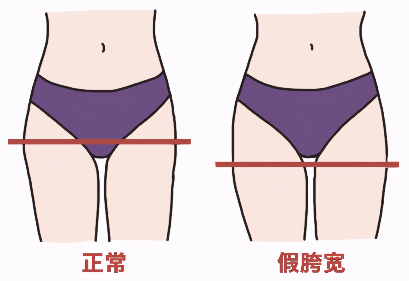 大腿粗是假胯宽还是肌肉腿,大腿粗是髋外展还是内收