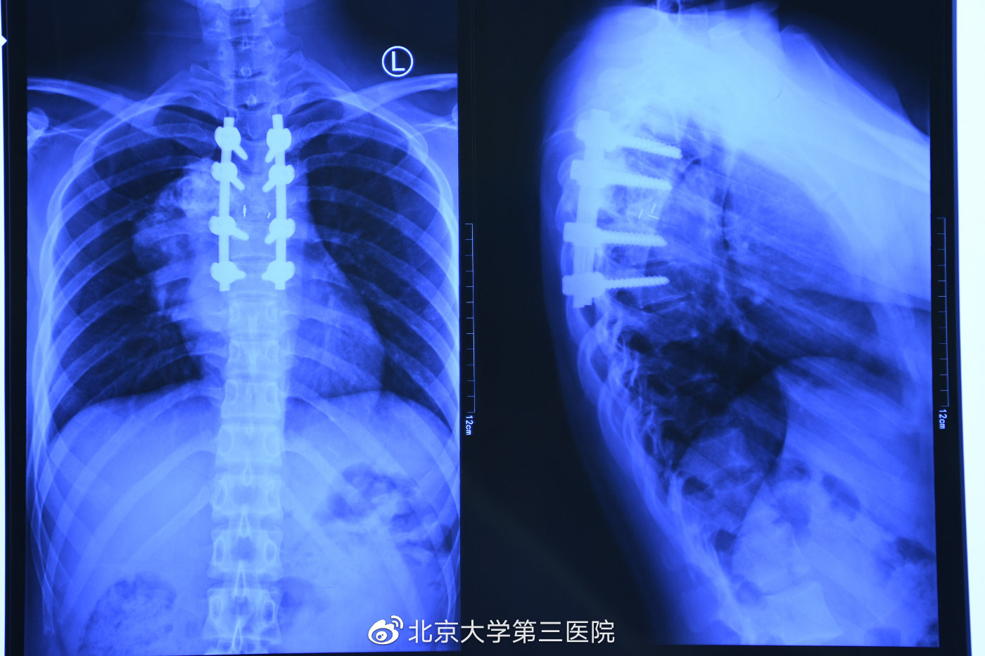 北医三院新消息,北医三院预约手术进度