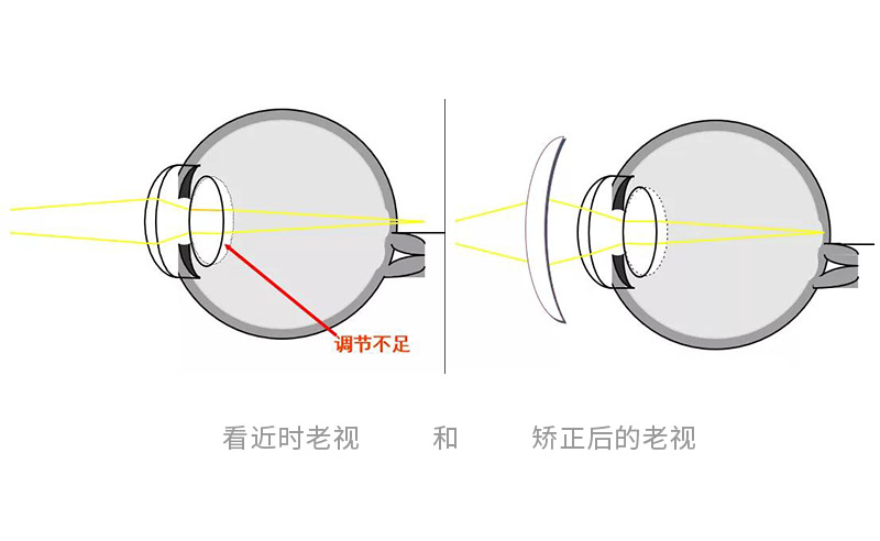 有近视和散光加老花怎么配镜,400度近视100度老花怎么配镜