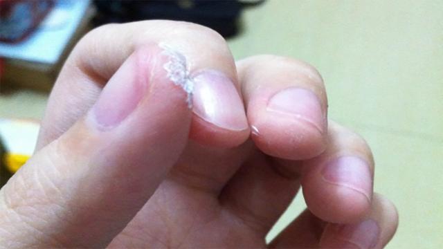 3岁男孩误食502胶水,父亲的做法医生忍不住称赞