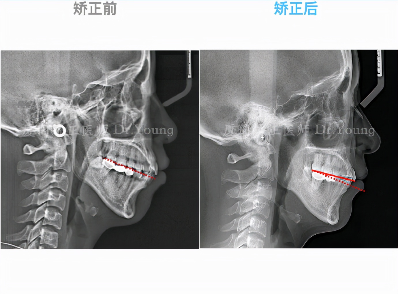 上颌前突下颌后缩是骨性还是牙性,厦门牙齿凸嘴矫正