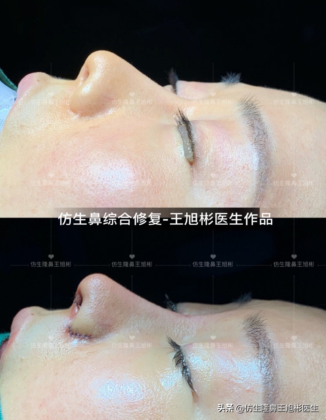 隆鼻的骨粉不取出有什么危害,骨粉隆鼻没有不适需要取出吗