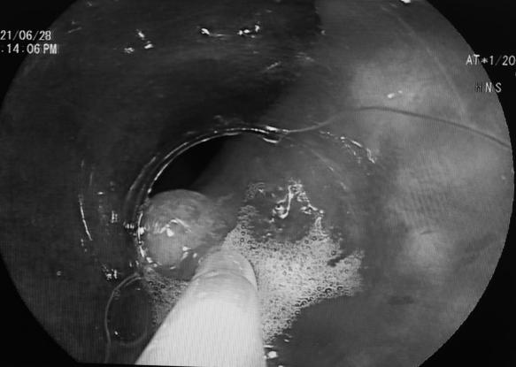 南大二附院消化内科谢正元教授团队完成院内首例内镜下弥漫性直肠静脉畸形扩张出血硬化剂注射止血术