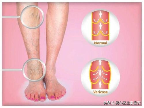 精索静脉曲张显微镜下手术危害,仰卧起坐对精索静脉曲张有危害吗