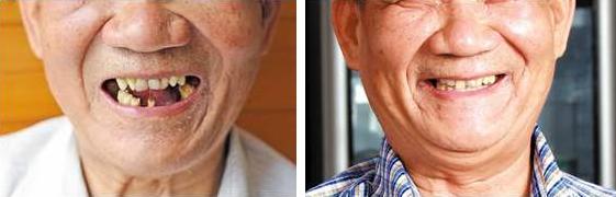 老年人种植牙需做哪些检查,老人种植牙齿注意事项