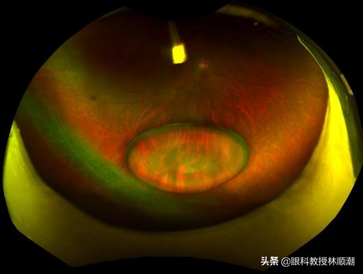 50岁男子用头顶了个球,晶状体脱位,悲剧了