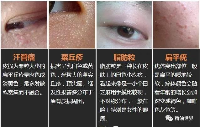 为什么会长脂肪粒,为什么会长脂肪粒眼部
