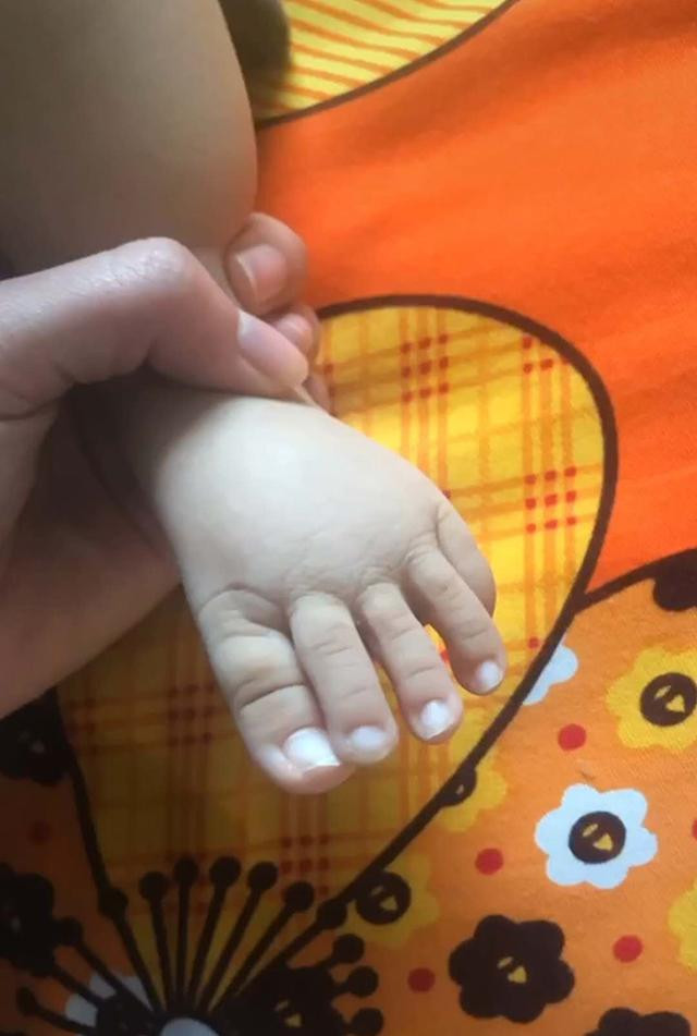 宝宝脚趾长怎么办,宝宝多长了一个小脚趾怎么办