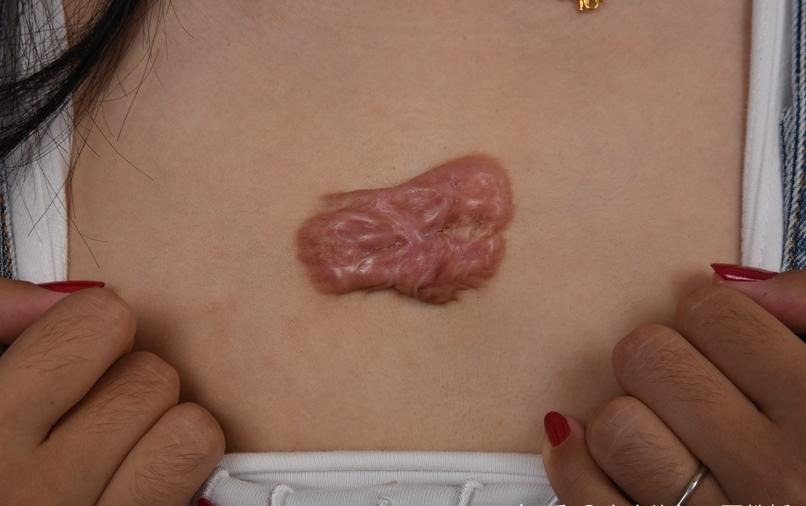 胸前疤痕疙瘩祛疤手术一般多少钱,疤痕疙瘩胸前激光去除需要多少钱