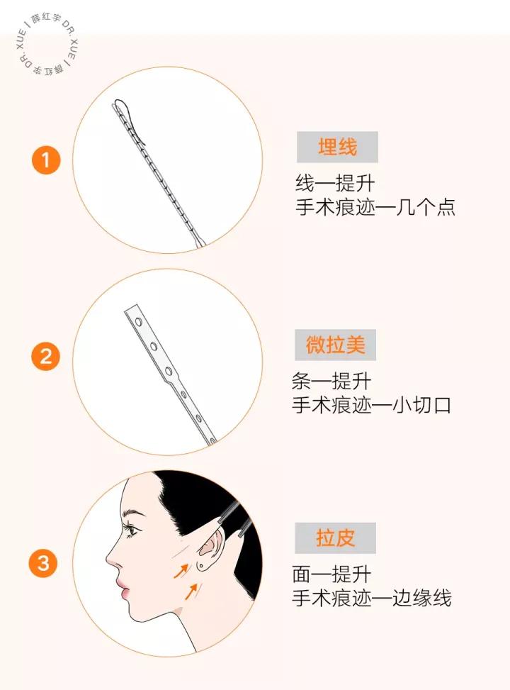 面部吸脂可以瘦脸,面部吸脂全脸什么部位不能吸