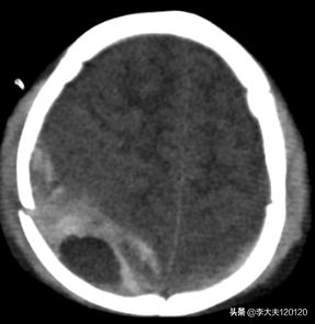 孩子额头被东西砸伤怎么处理,儿童头部摔伤后该如何做应急处理
