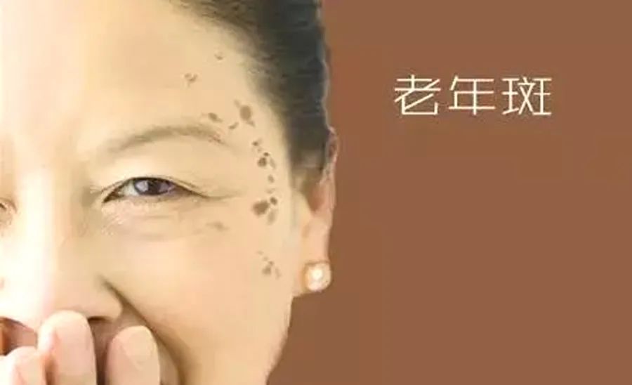 老年人皮肤癌图样,老年斑反复结痂脱落是不是皮肤癌