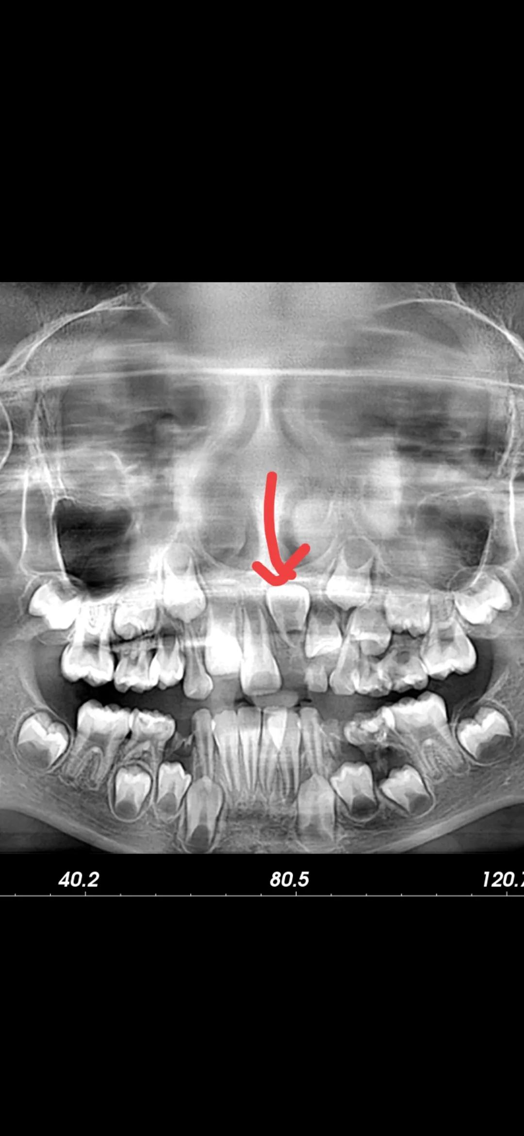 40岁后牙齿注意事项,5岁儿童换牙齿需要注意什么