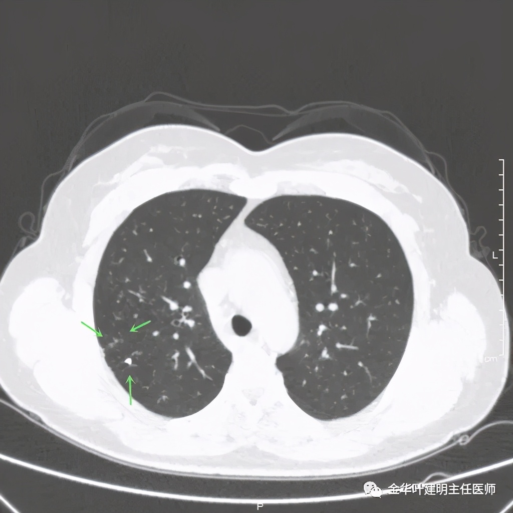 右上肺结节灶一般是什么癌,右上肺恶性肿瘤是肺癌吗