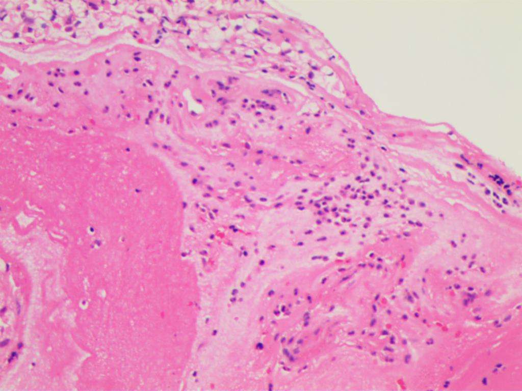 宫颈癌的6个信号是怎么回事,宫颈癌的前兆有哪些问题能发现