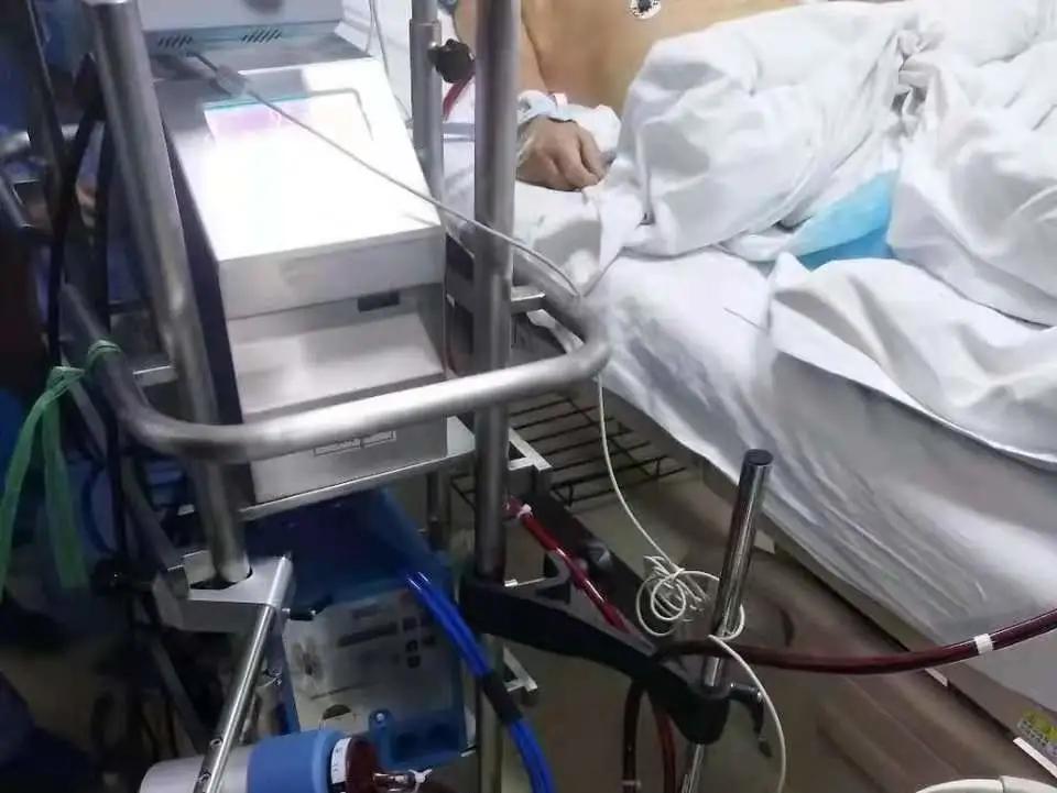 ecmo体外膜肺呼吸机,体外膜肺氧合可治愈心衰吗