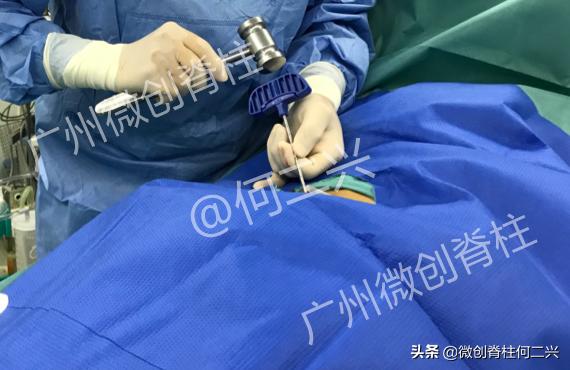 精准微创治疗案例：针尖上的技术——微波消融治疗脊柱转移性肿瘤