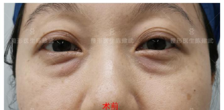 37岁小姐姐分享：眼袋消失后，卧蚕开始尽情展现魅力