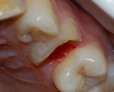 牙齿缺失牙根还在的最佳修复方法,缺失一颗牙齿可以拔掉不修复吗