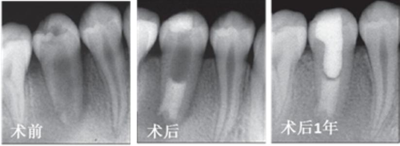 牙髓坏死了还能救回来吗？医生：这个技术很多人不知道