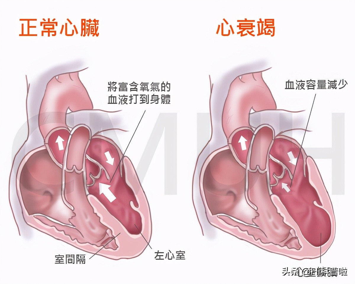 第四代磁悬浮人工心脏人民日报,中国成功研制出磁悬浮心脏了吗