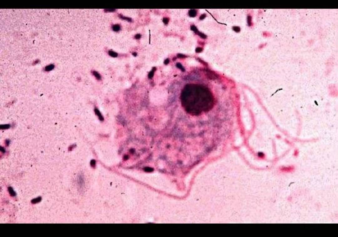 异味瘙痒白带泛黄是哪种妇科病,妇科瘙痒有异味白带多怎么办