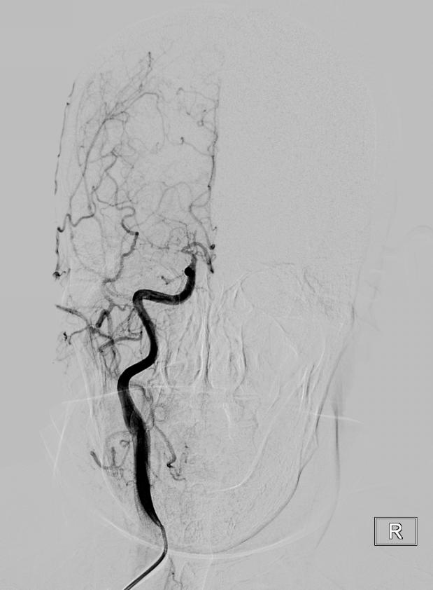 神经外科介入发展与规划,神经外科治疗脑血管病吗