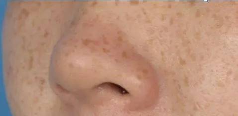 斑点美白最有效的正品祛斑霜,女士抗皱祛晒斑雀斑霜