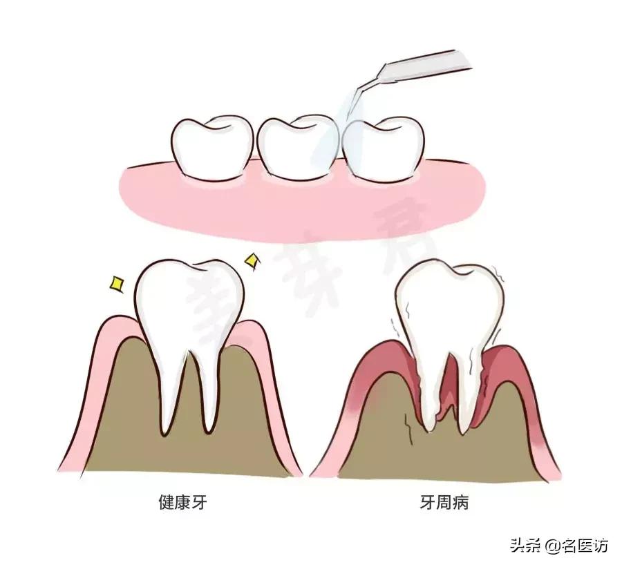 洗牙攻略,洗牙全攻略