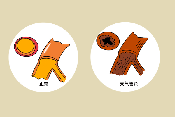 为什么一到晚上就咳嗽怎么缓解,咳嗽变异性哮喘为什么是夜间咳嗽