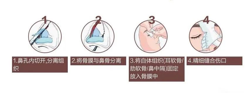 自体隆鼻的原因,鼻部自体脂肪隆鼻