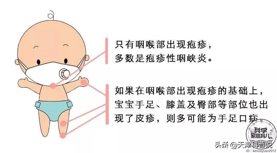 手足口病高发期快来看看怎样预防,手足口病进入高发期家长一定注意