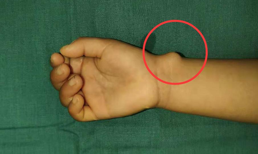 小孩会得腱鞘囊肿吗,6岁孩子腱鞘囊肿有必要手术吗