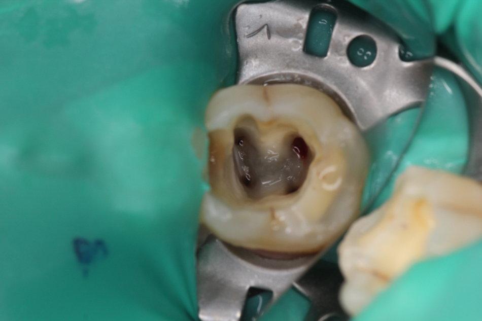 牙神经杀掉后再抽牙神经还会疼吗,抽过牙神经的牙齿是不结实了吗