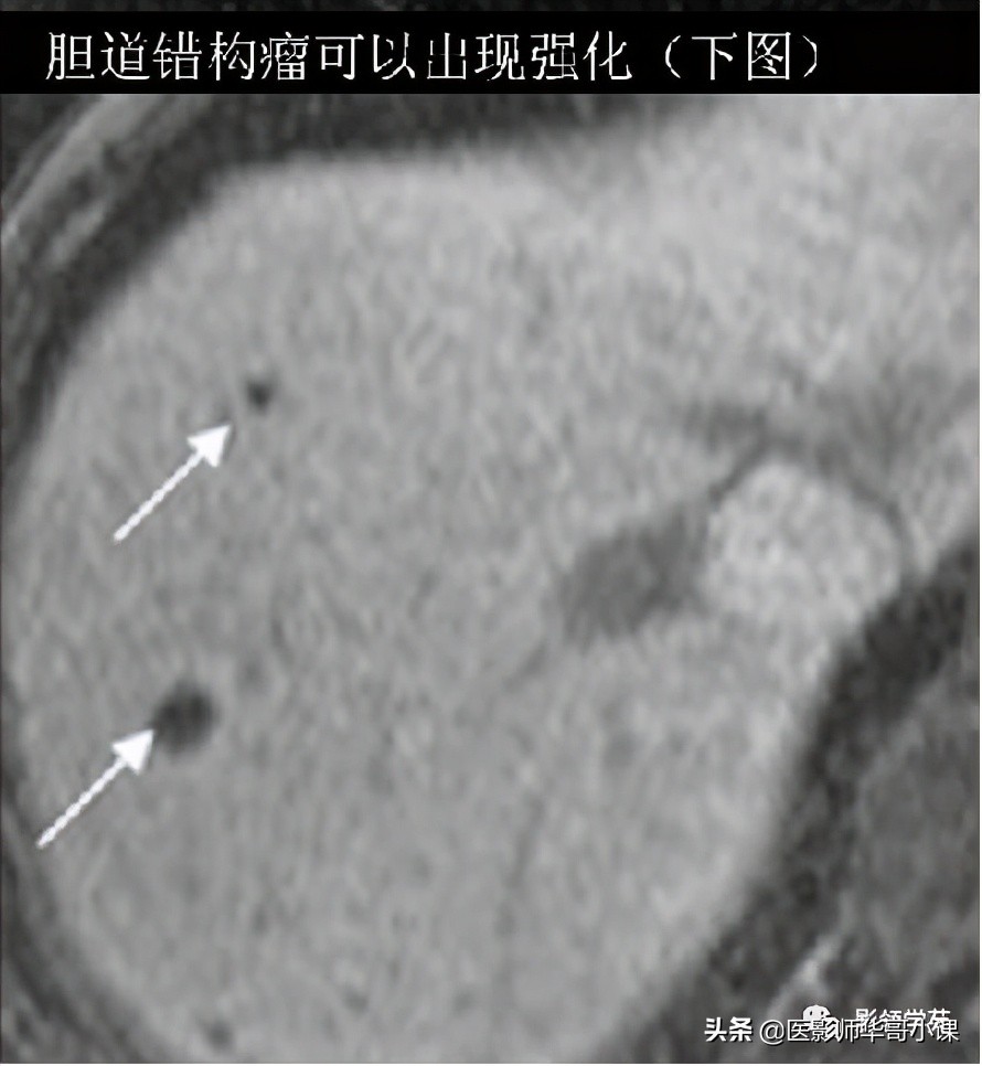胆总管变异,胆胰管解剖