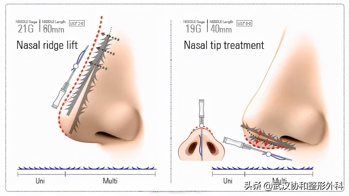 线雕隆鼻的副作用和危害,线雕隆鼻费用一般多少钱