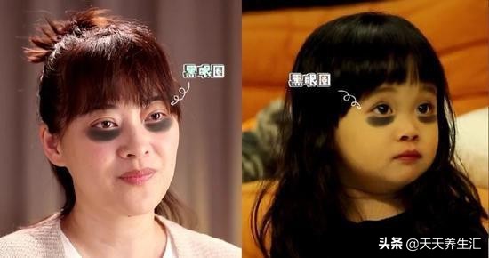 有黑眼圈是因为熬夜还是睡眠不足,失眠黑眼圈严重怎么改善黑眼圈