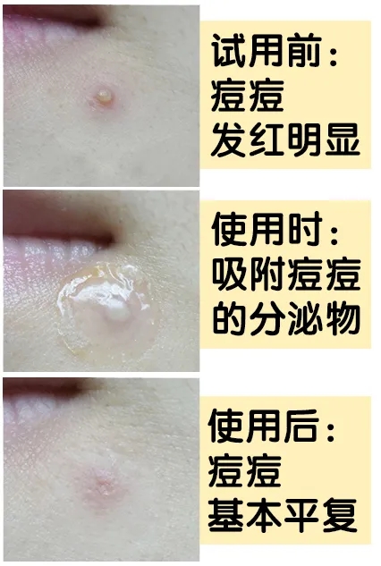 片仔癀祛痘痘产品,片仔癀可以改善痘痘肌吗