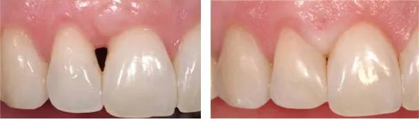 牙龈里的黑东西是什么,牙龈间有黑东西怎么办