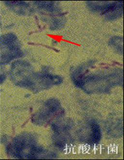 怀疑肺结核一定要查三次痰吗,医生怀疑是肺结核的几率有多大